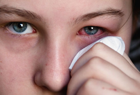 Conjunctivitis-Watch Out For Pink Eyes In The Wet Season