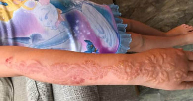 Avoid Black Henna Tattoos Or Risk Permanent Scaring