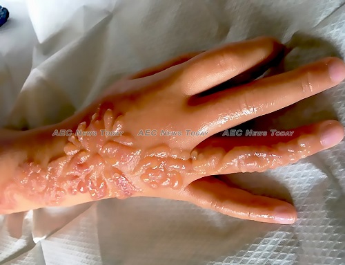 black henna tattoos contain chemical substance that can cause severe allergic reactions, blisters, open sores, and scarring 